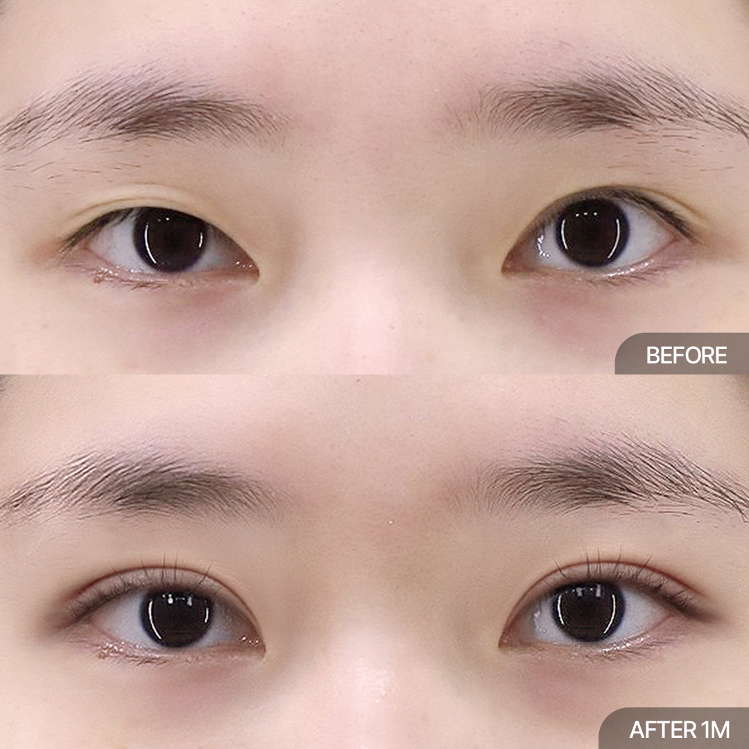 12홀 자연유착