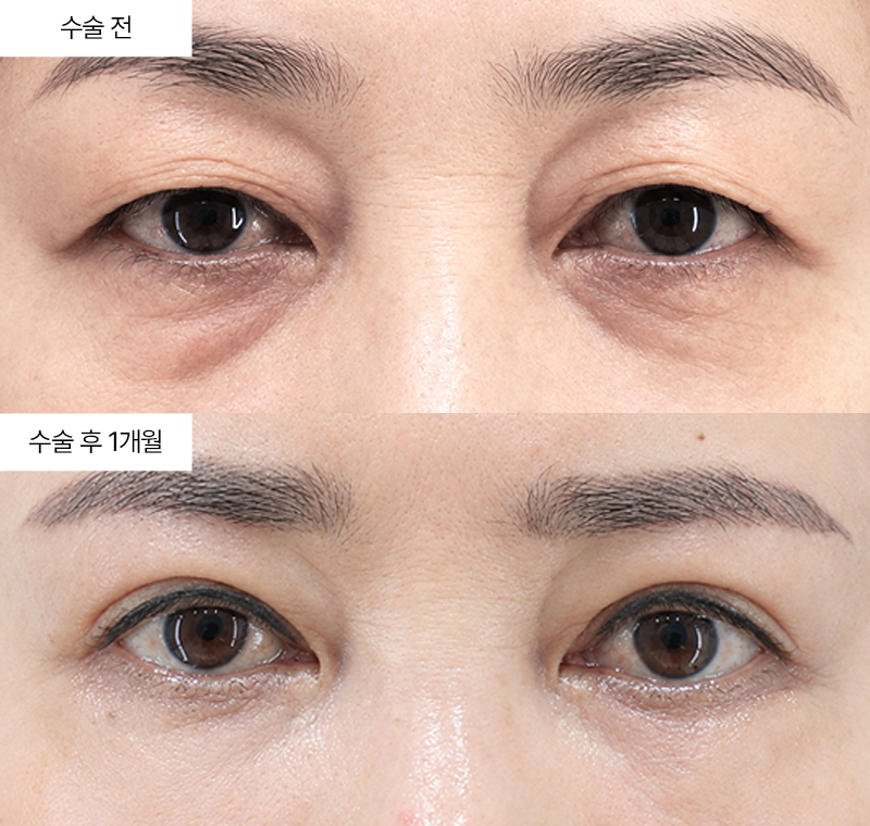 눈썹하거상+12홀자연유착+눈위지방제거+하안검
