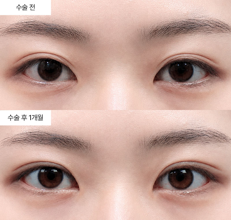 12홀 자연유착