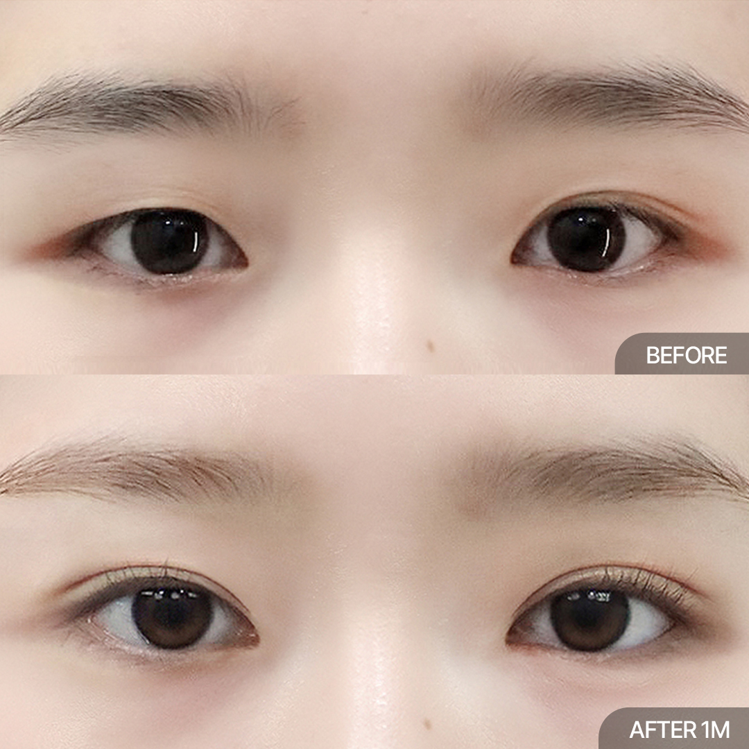 12홀 자연유착+눈매교정+윗트임+앞트임