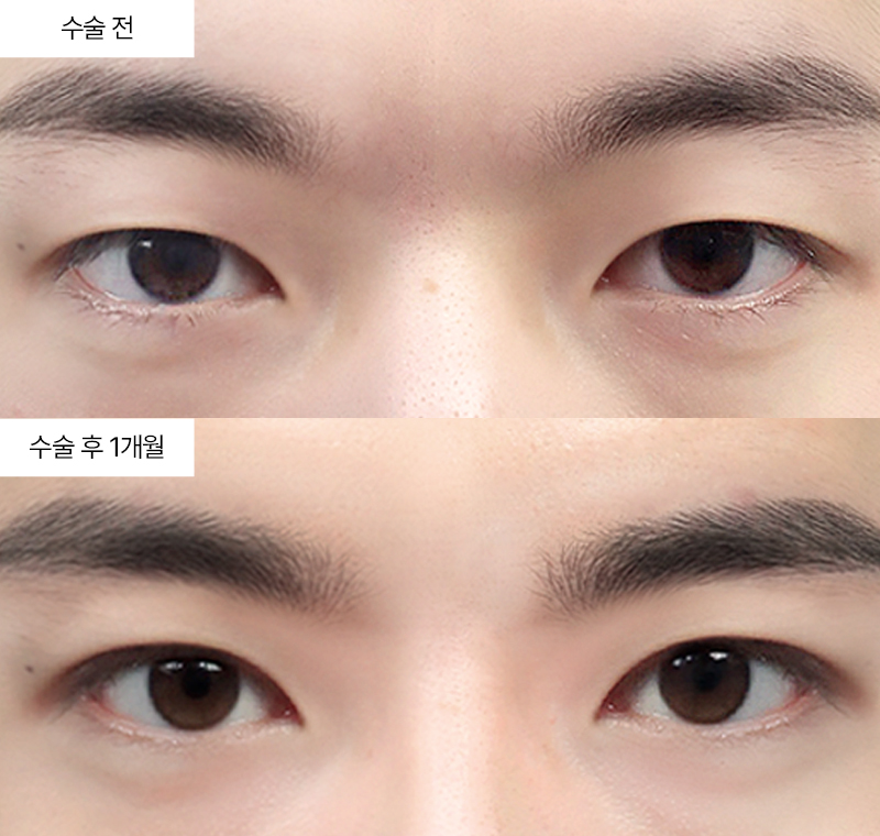 12홀자연유착+윗트임
