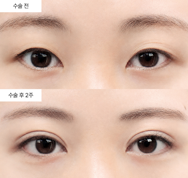 12홀 자연유착+눈매교정+뒤트임+눈꼬리내리기