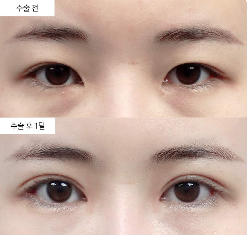 12홀 자연유착 + 앞트임 + 눈매교정 + 뒷트임