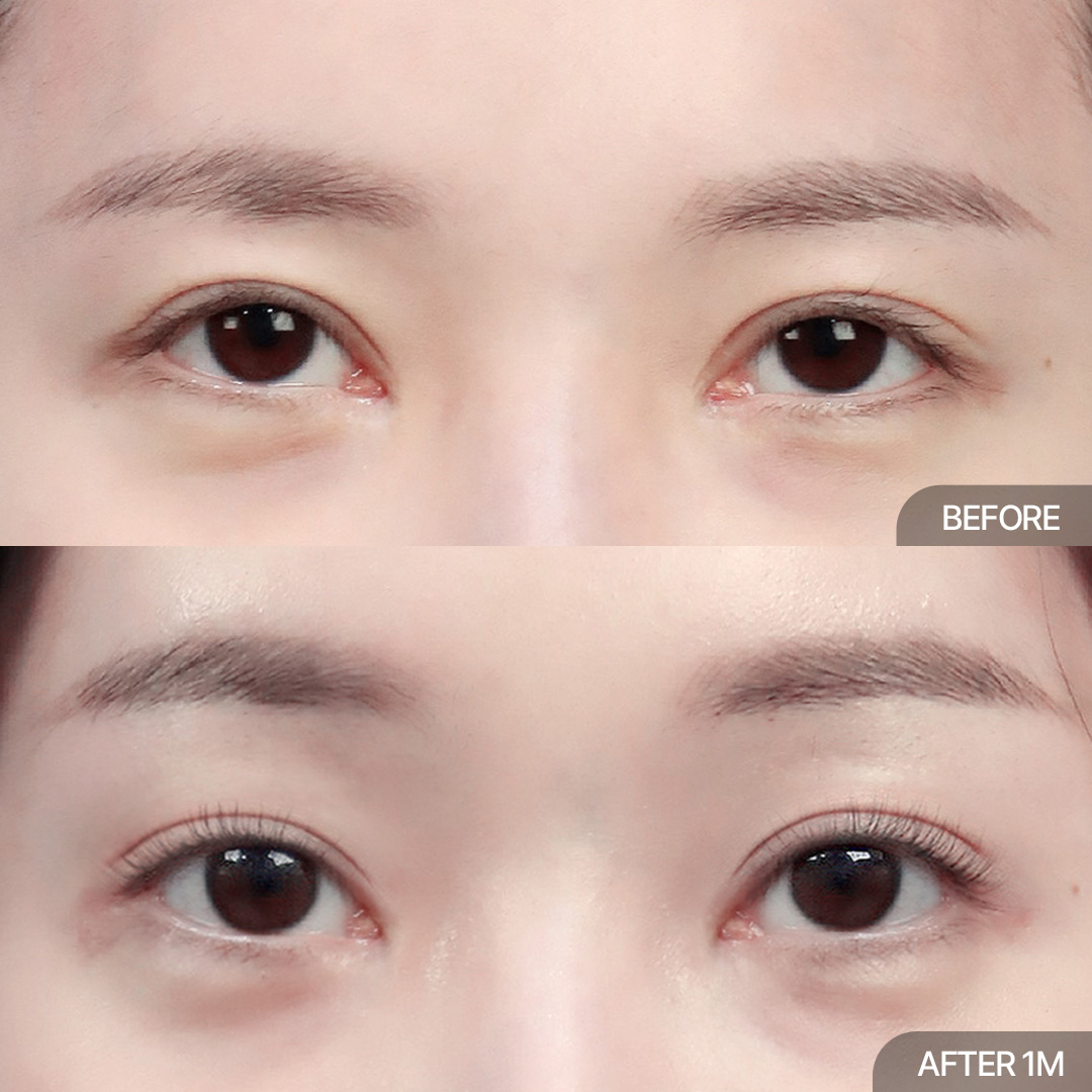 이마거상+12홀 자연유착+윗트임