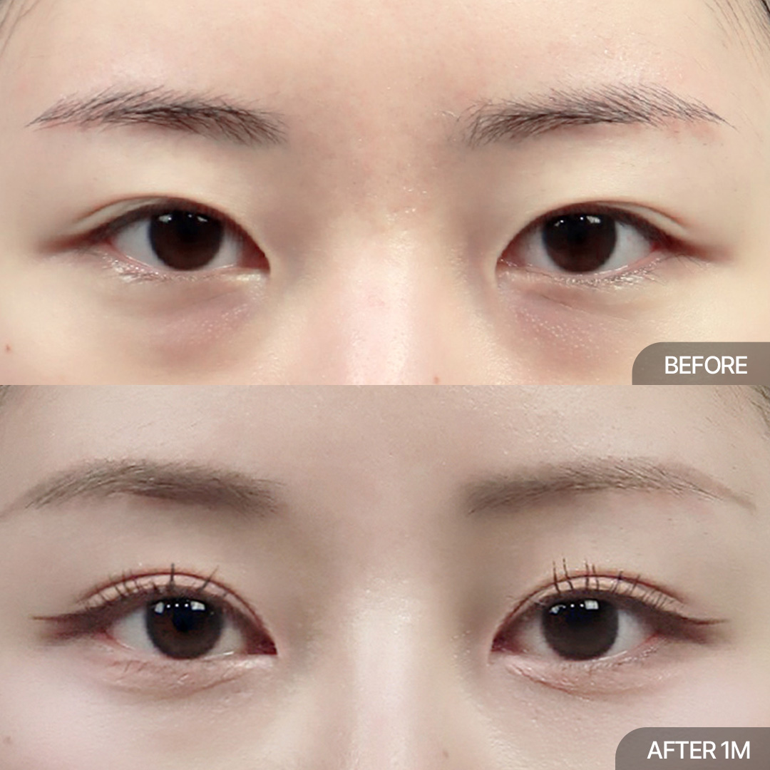 12홀 자연유착+눈매교정+윗트임