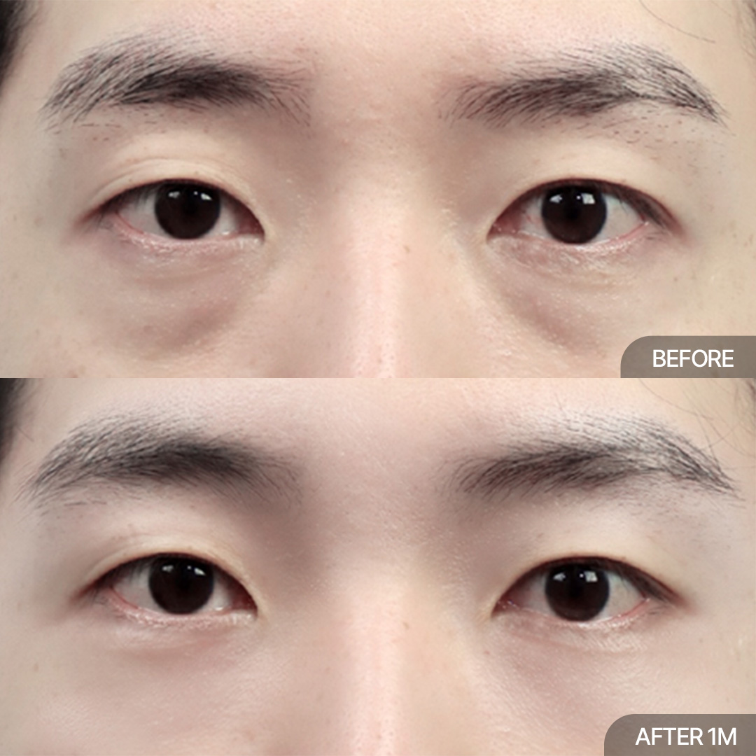눈밑지방재배치