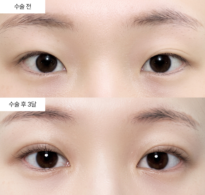 자연유착+눈매교정+앞트임+윗트임
