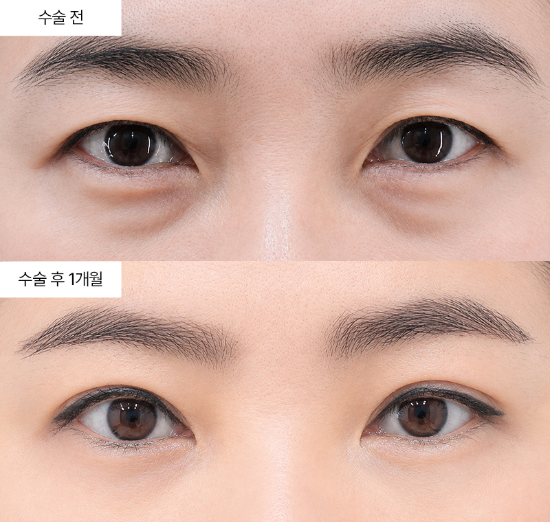 눈썹하거상+12홀 자연유착+눈밑지방재배치