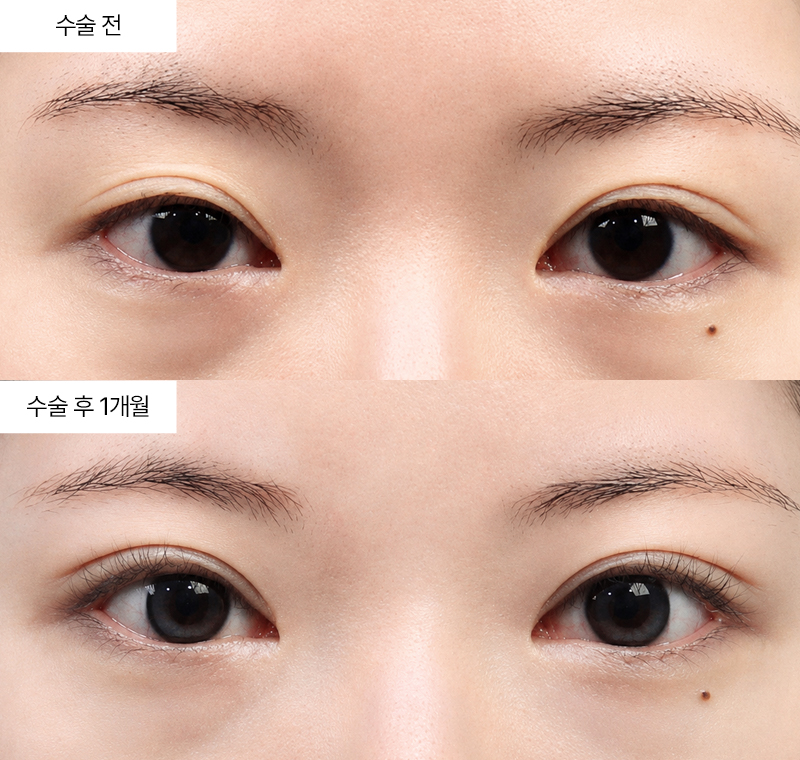 12홀 자연유착+눈매교정+윗트임+밑트임