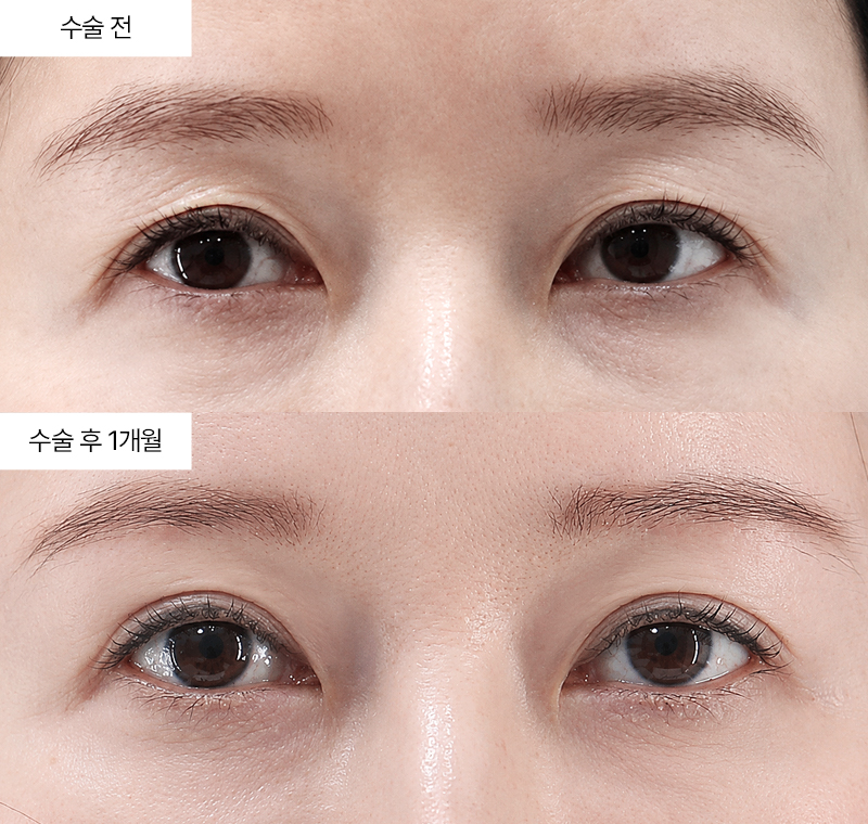 눈썹하거상