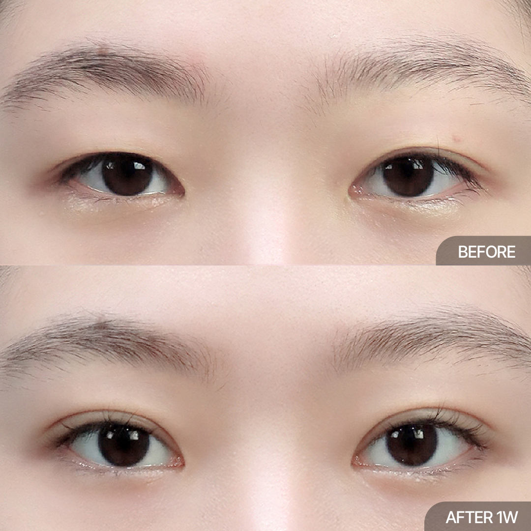 12홀 자연유착+눈매교정+윗트임+앞트임