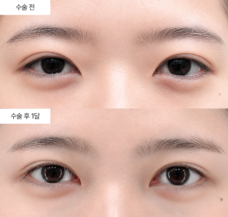 앞트임+윗트임