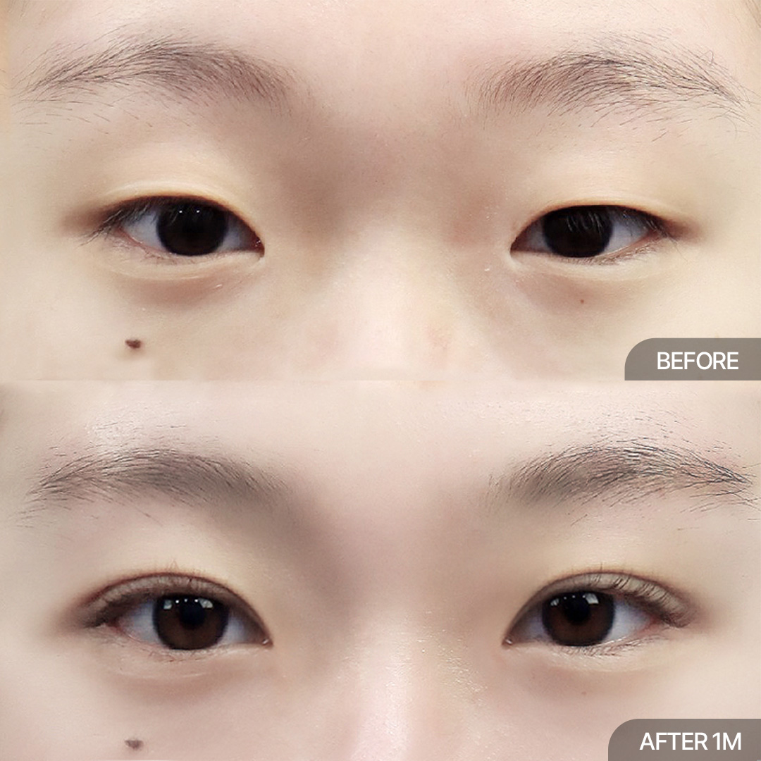 12홀 자연유착+눈매교정+위트임+앞트임