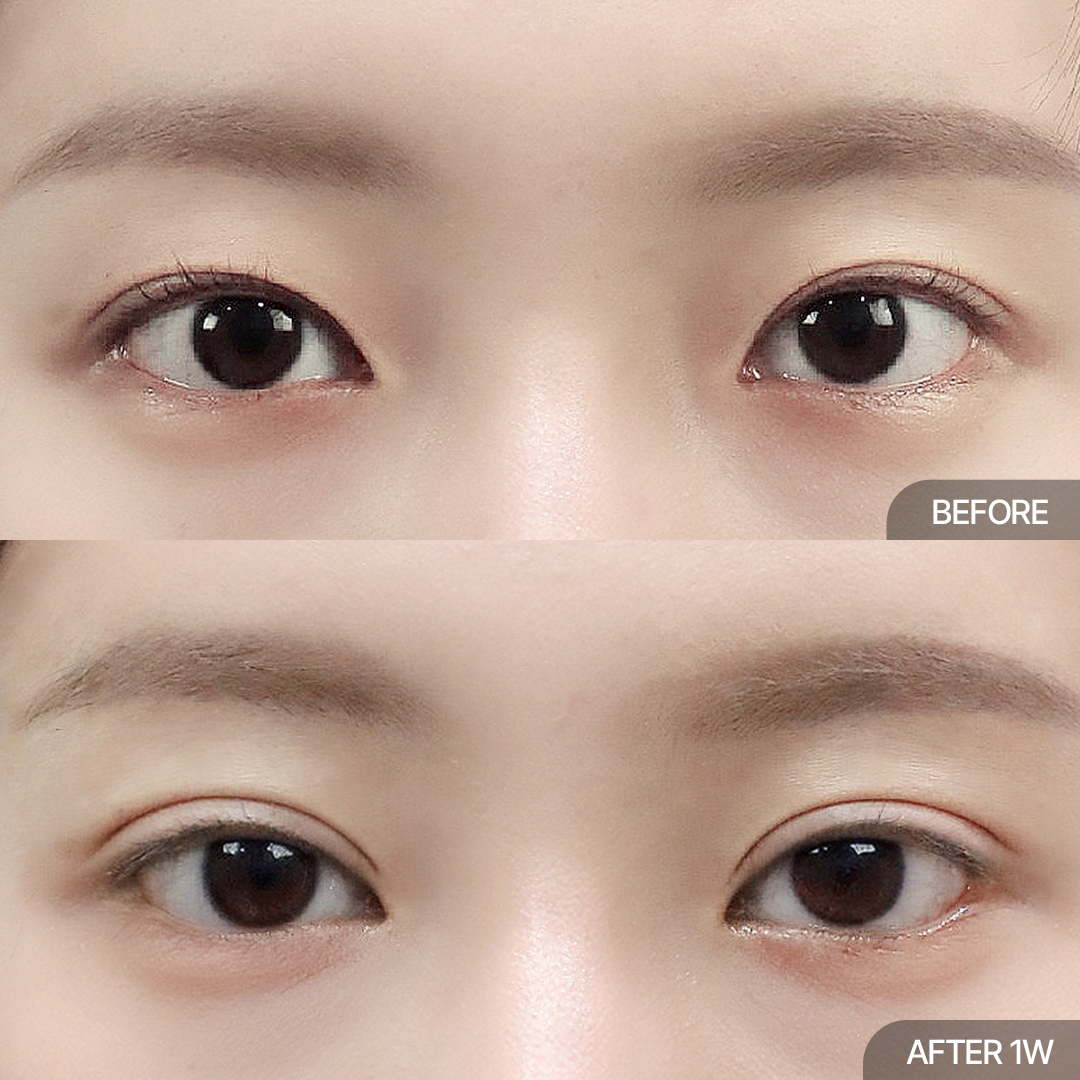12홀 자연유착+윗트임