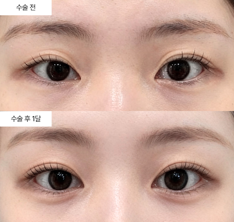 12홀 자연유착+눈매교정