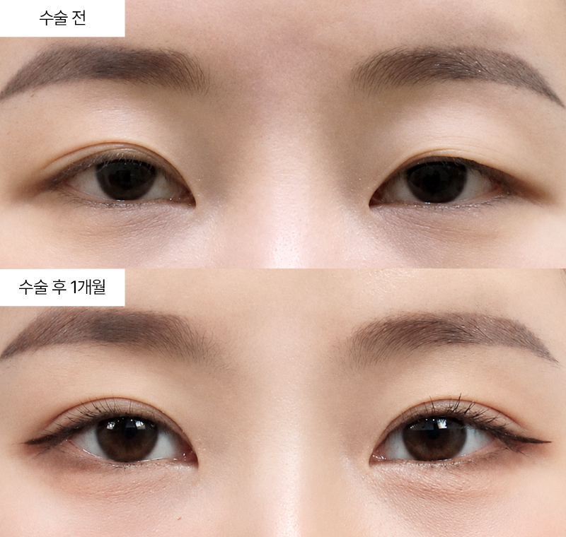 12홀자연유착+눈매교정+윗트임