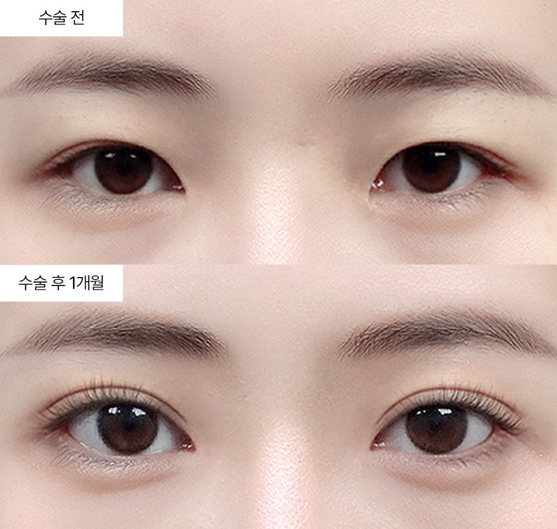 12홀 자연유착+앞트임+윗트임+뒤트임+밑트임