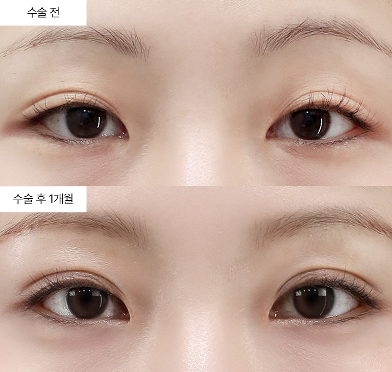 12홀 자연유착+눈매교정+윗트임+앞트임