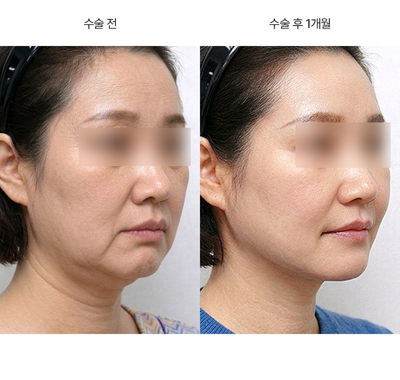 안면거상+목거상
