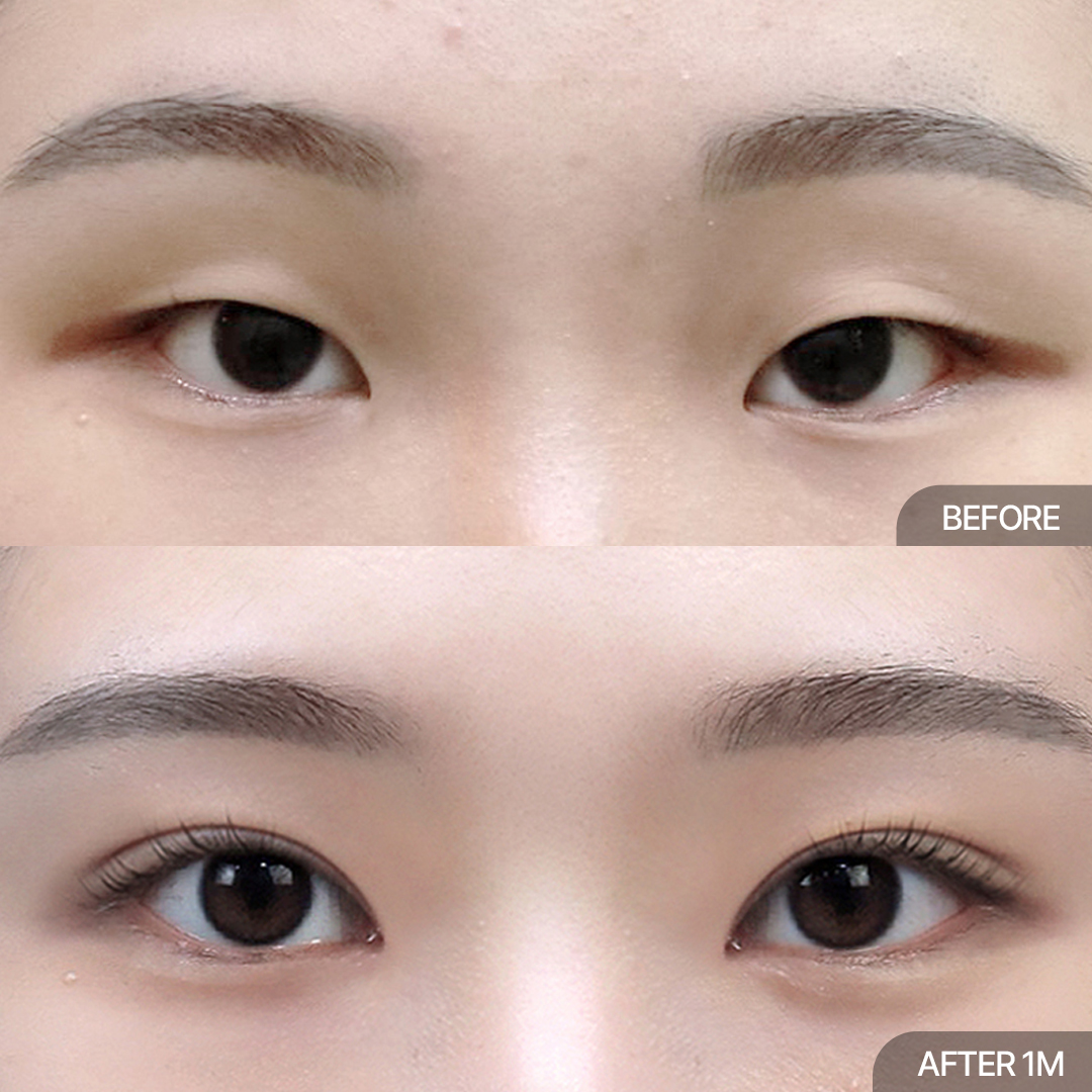 12홀 자연유착+윗트임+앞트임