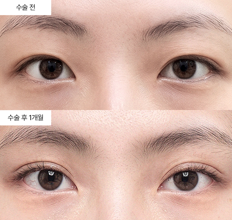 12홀 자연유착+눈매교정+윗트임+앞트임