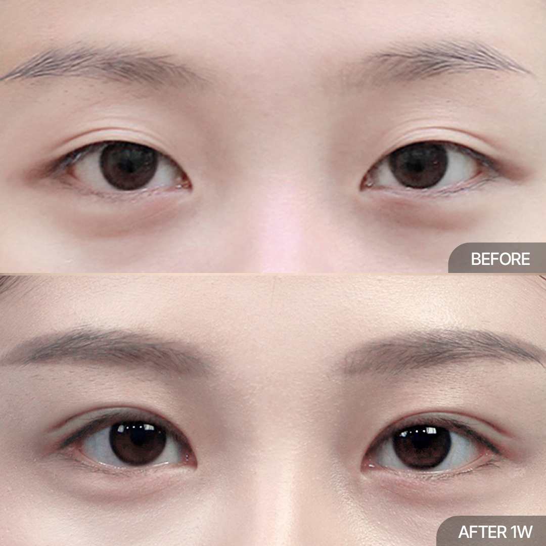12홀 자연유착+윗트임