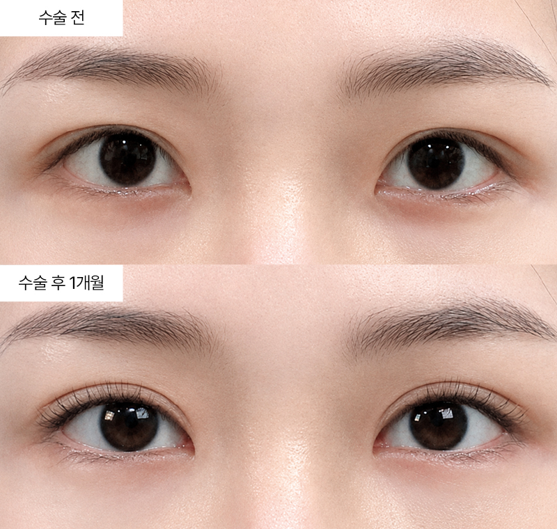 12홀 자연유착+윗트임+앞트임