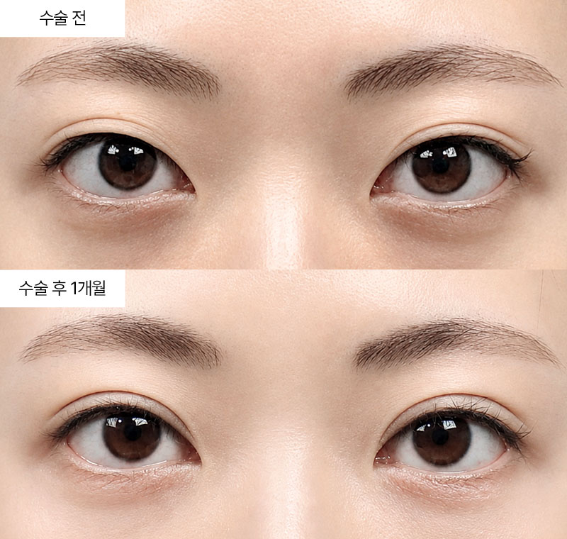 12홀 자연유착