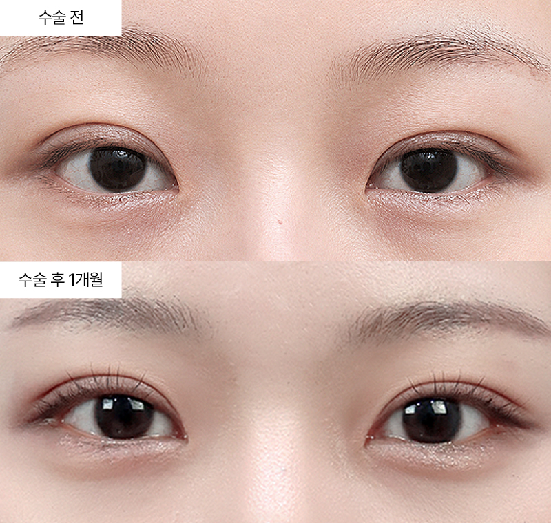 12홀 자연유착+윗트임+밑트임