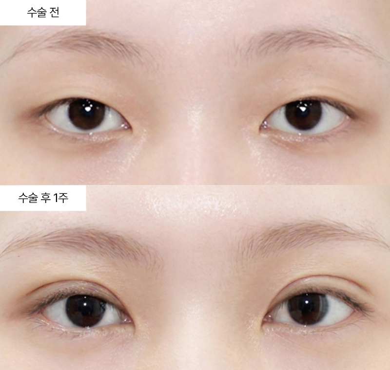 자연유착+눈매교정+앞트임+윗트임