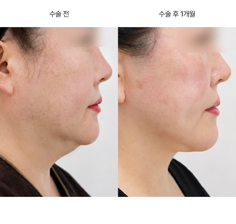미니거상+이중턱 흡입+근육묶기