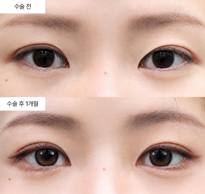 뒤트임+밑트임