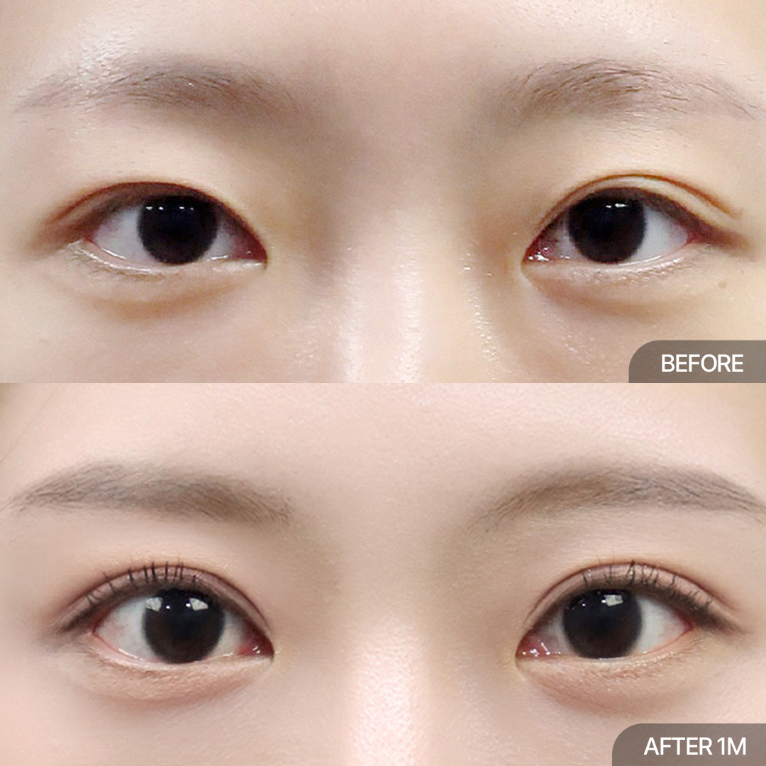 12홀 자연유착+윗트임