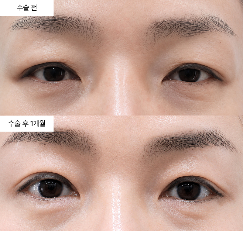 상안검+눈매교정+윗트임