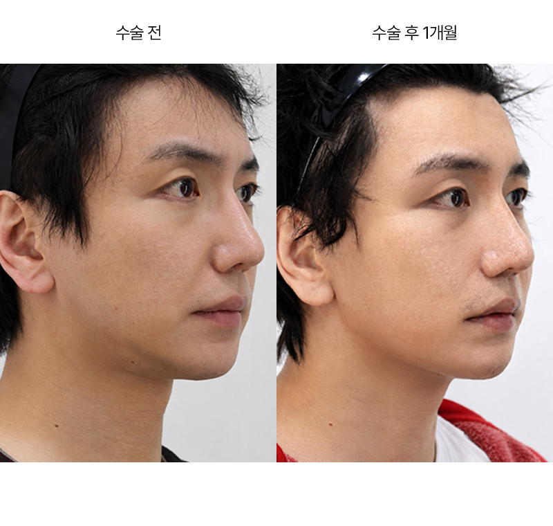 안면거상