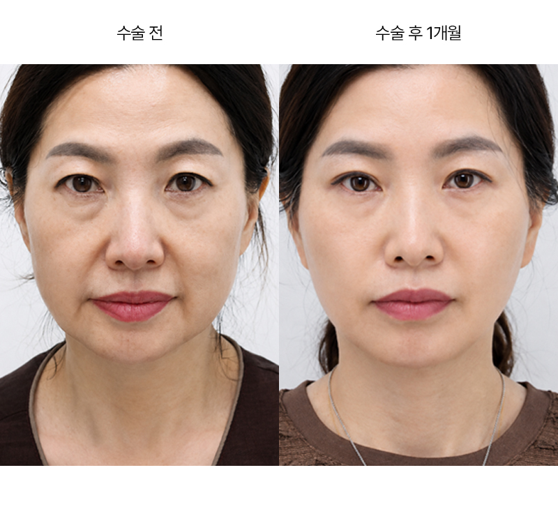 안면거상+이마거상+12홀 자연유착+윗트임