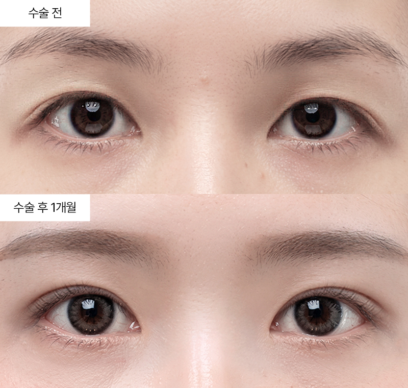이마거상+12홀 자연유착