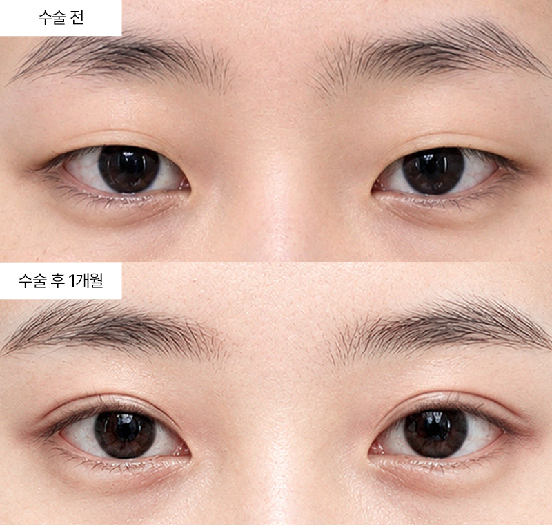 12홀 자연유착+앞트임+윗트임+밑트임