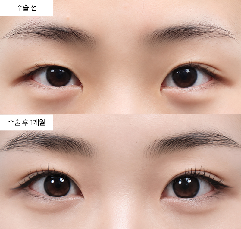 12홀 자연유착+윗트임+앞트임