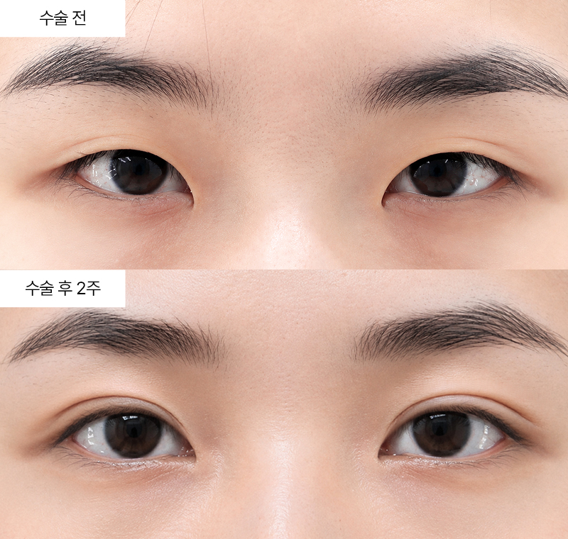 12홀 자연유착+윗트임+앞트임