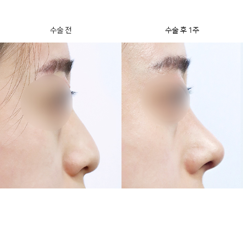 코끝 + 매부리 교정
