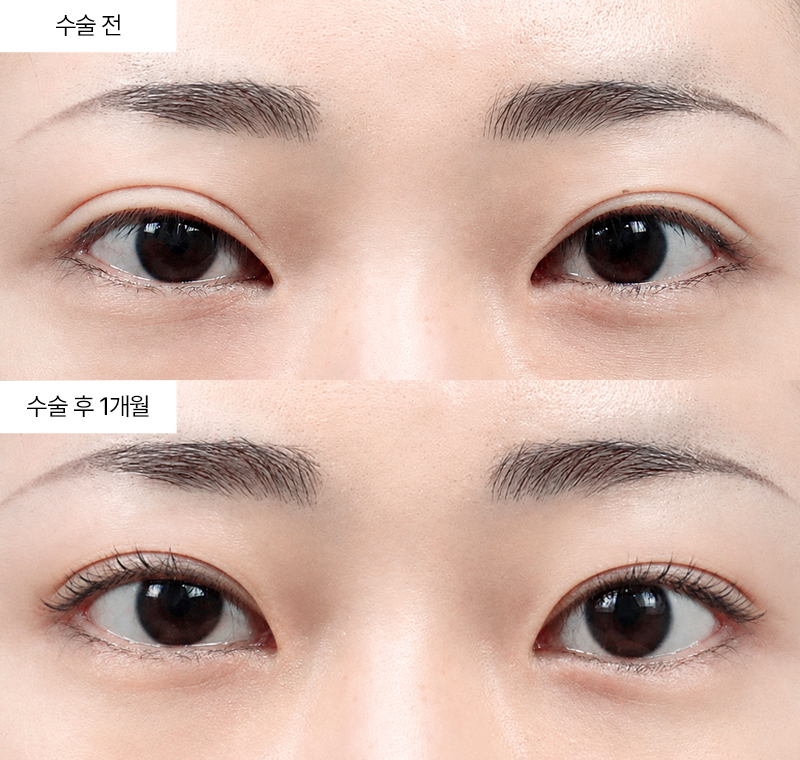 두줄따기+눈매교정+윗트임+뒤트임+밑트임