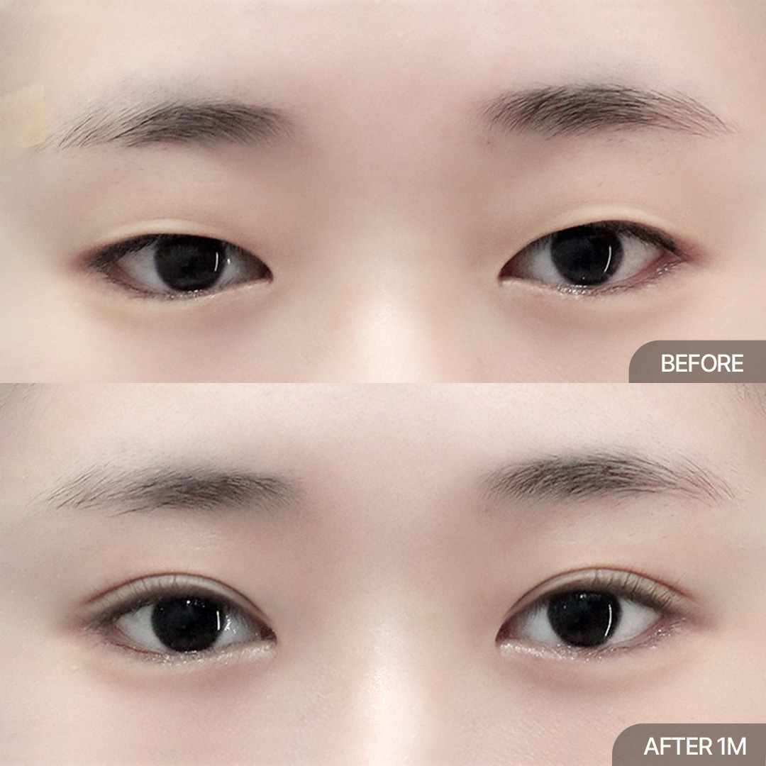 12홀 자연유착+눈매교정