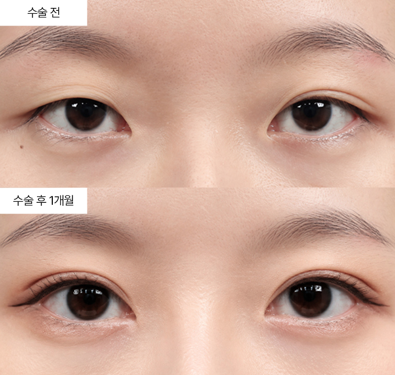 절개+눈매교정+앞트임+윗트임+뒤트임+밑트임