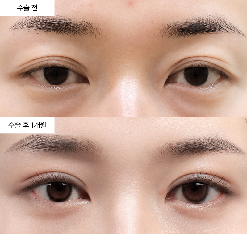 12홀 자연유착+눈매교정+윗트임