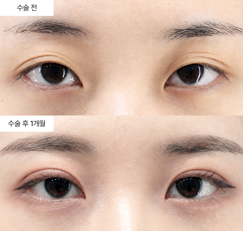 12홀 자연유착+눈매교정