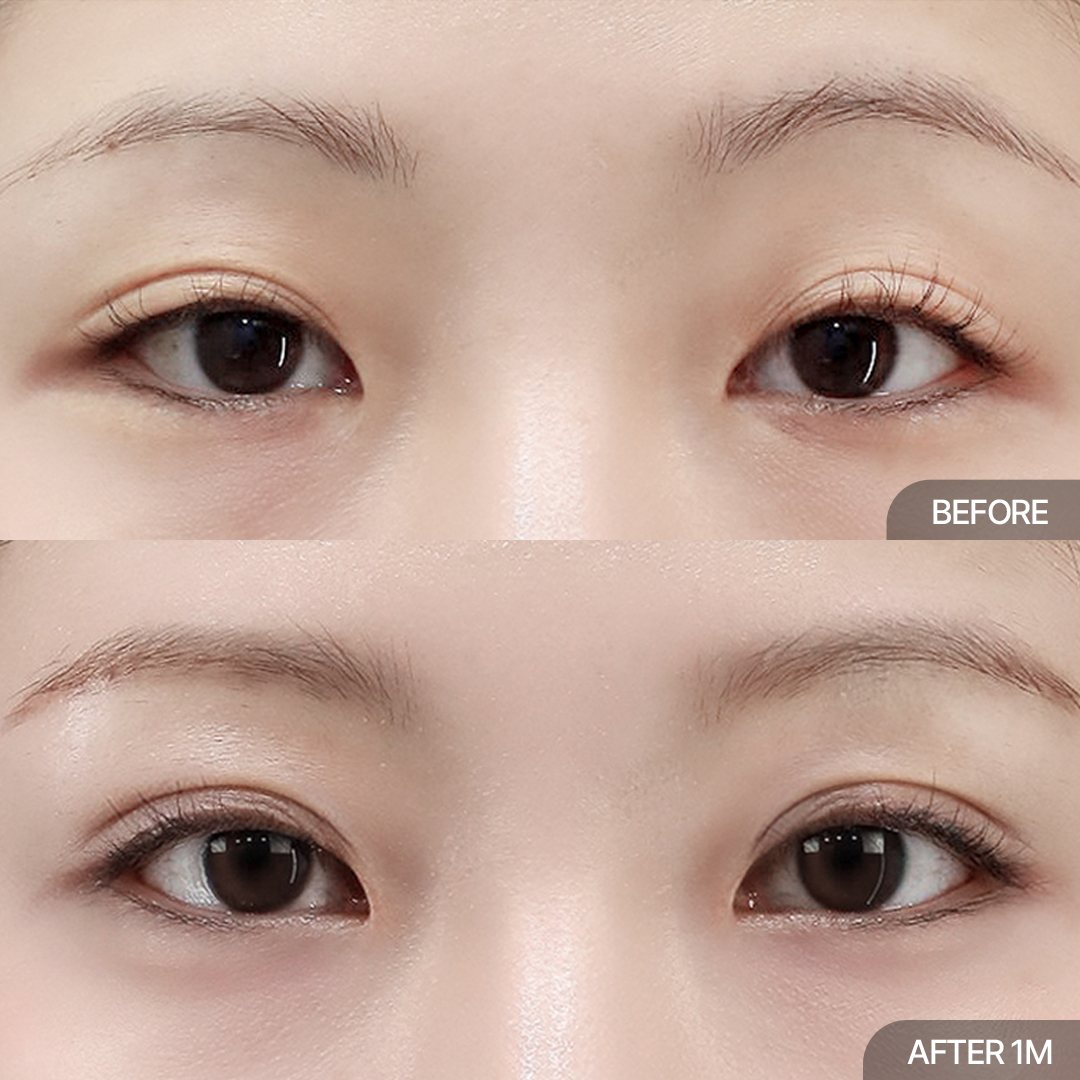 12홀 자연유착+눈매교정+윗트임+앞트임