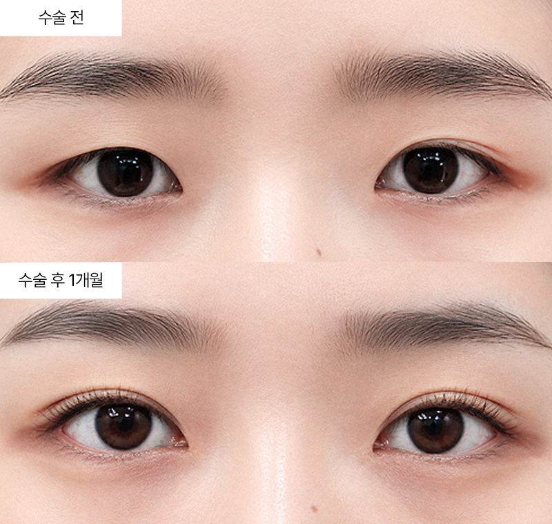 12홀 자연유착+윗트임+앞트임
