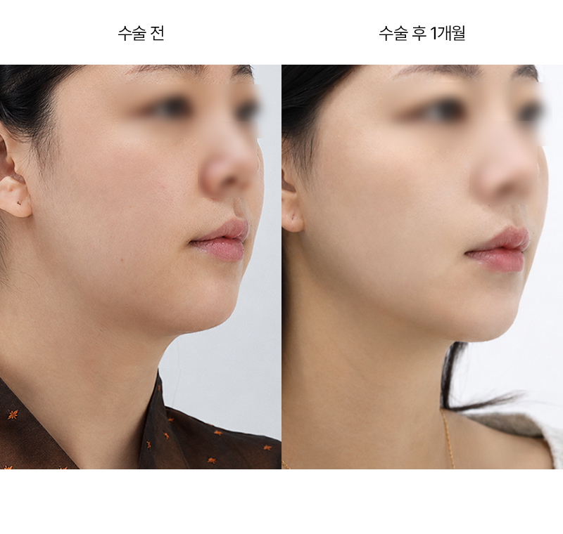 미니거상+이중턱근육묶기