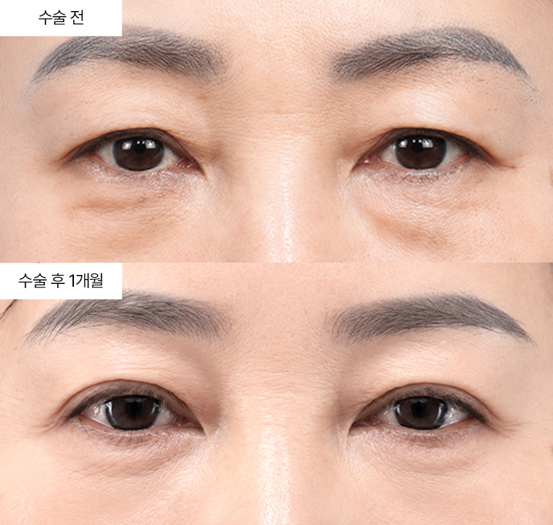 상안검+하안검